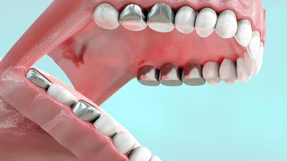 dentist explaining mercury in Dental Amalgam Carlsbad