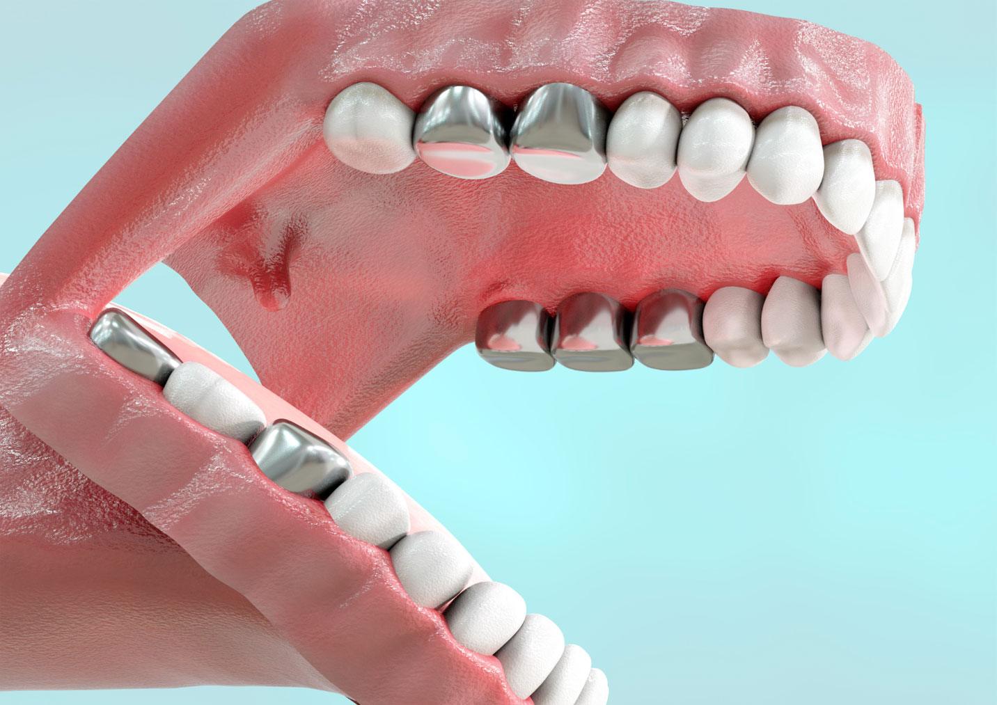 dentist explaining mercury in Dental Amalgam Carlsbad