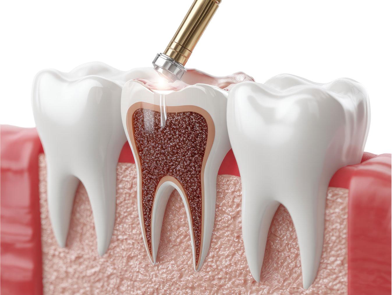 Dental X-ray used to plan root canal Carlsbad treatment