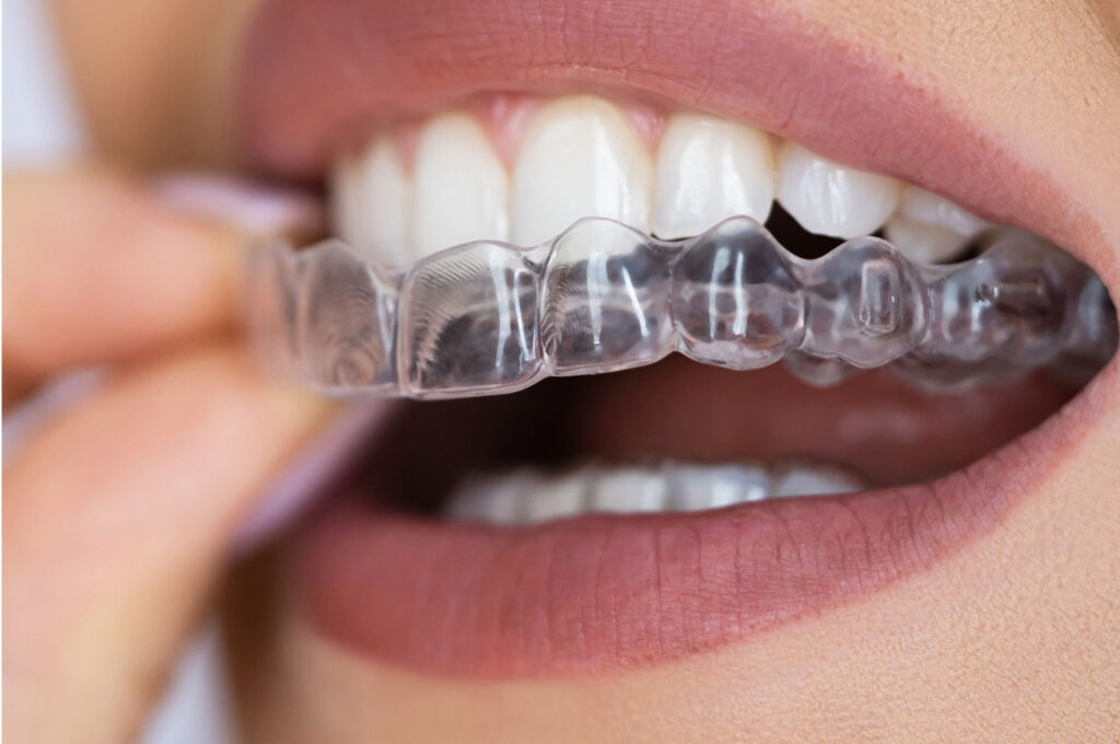 Invisalign clear aligners close-up on teeth