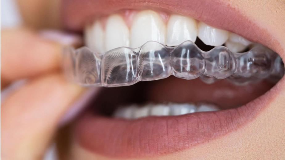 Clear Aligners in Carlsbad