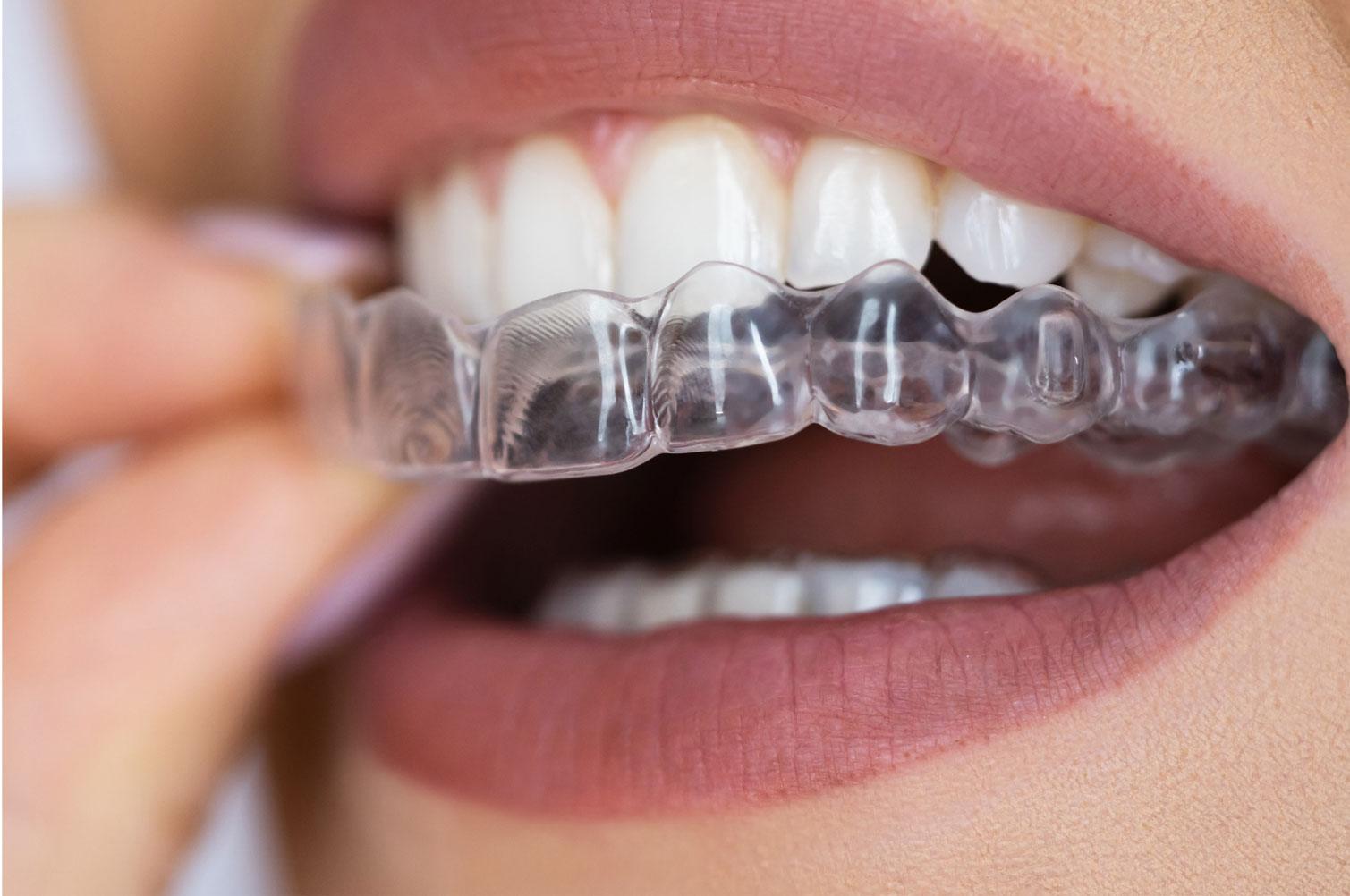 Clear Aligners in Carlsbad