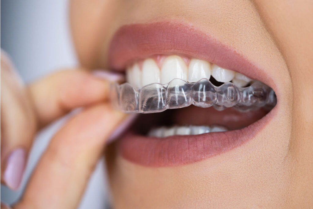 removable aligners for discreet teeth straightening
