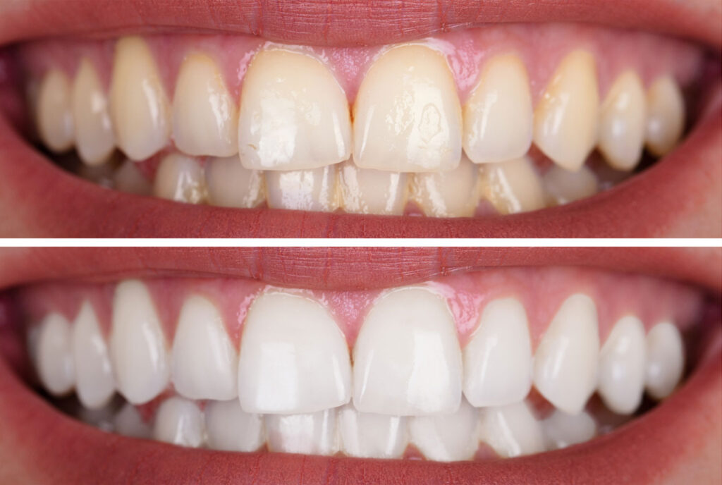 remove yellow stains Carlsbad teeth whitening consultation
