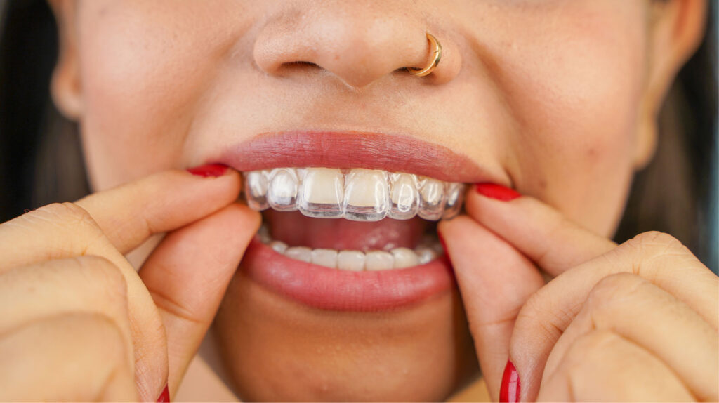 clear aligner trays for teeth straightening without braces