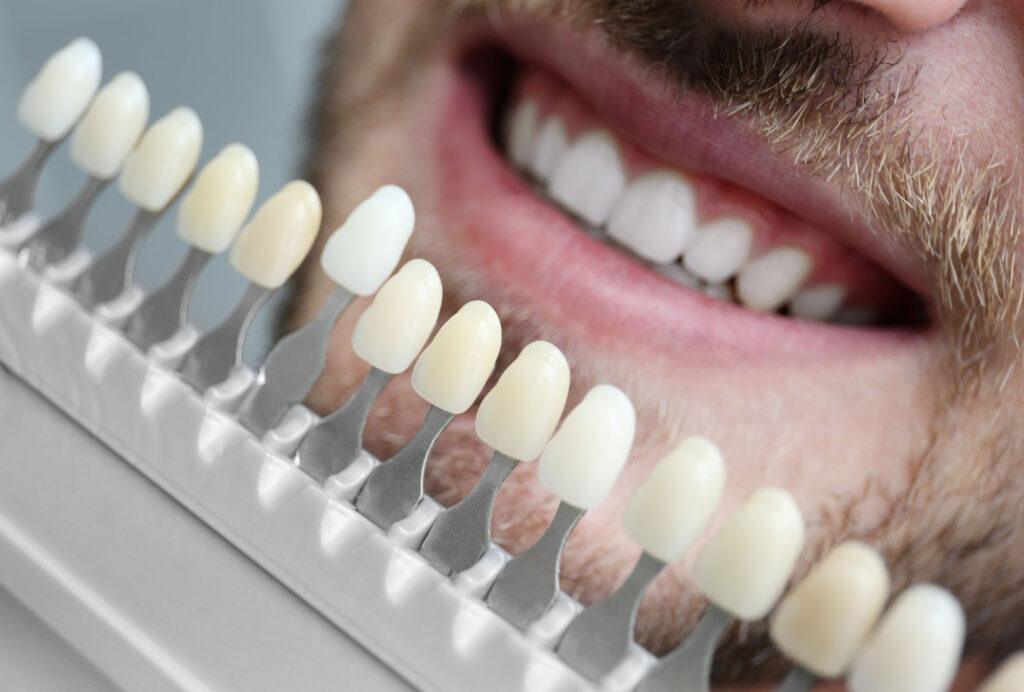 Dental Veneers Carlsbad