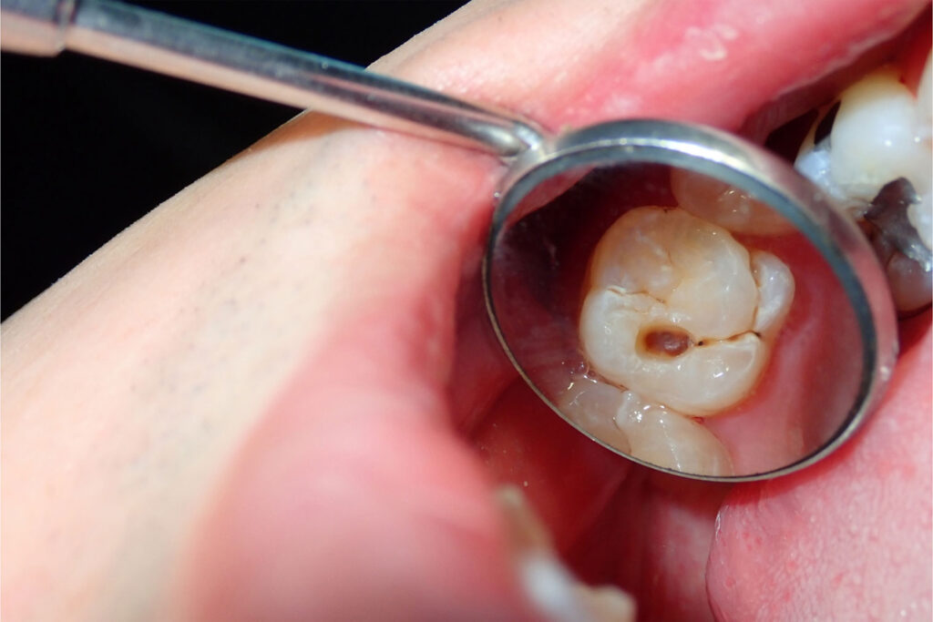 dentist searching cavities after fluoride treatment to protect enamel