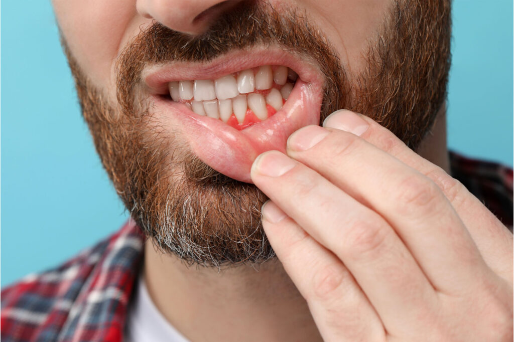 worn enamel and gum recession causing sensitive teeth