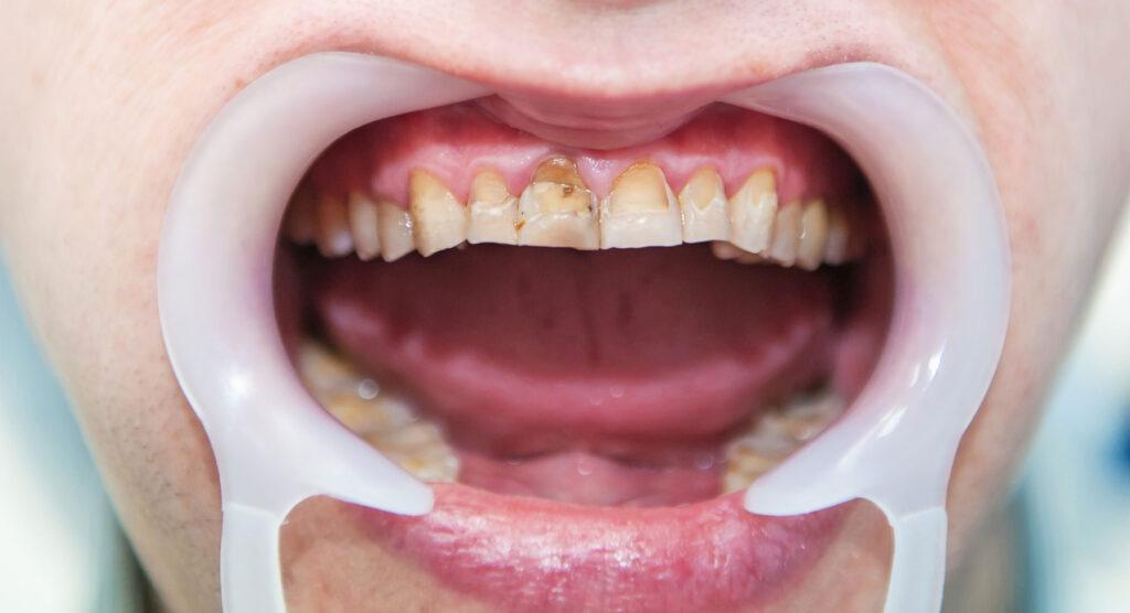 teeth whitening consultation for stubborn discoloration in Carlsbad