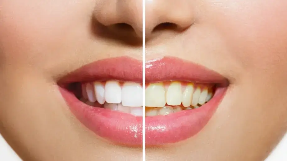 Causes of Tooth Discoloration