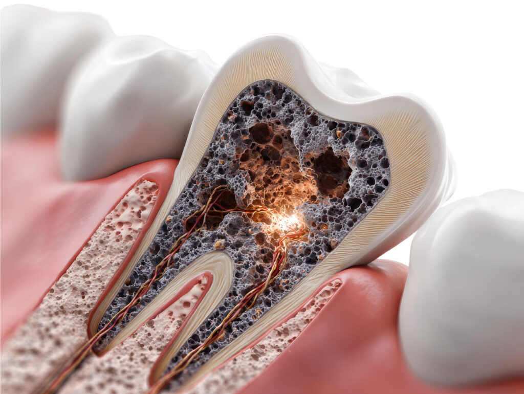 cavity treatment Carlsbad dental exam for early decay detection
