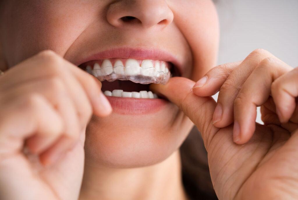 custom night guard for teeth grinding Carlsbad