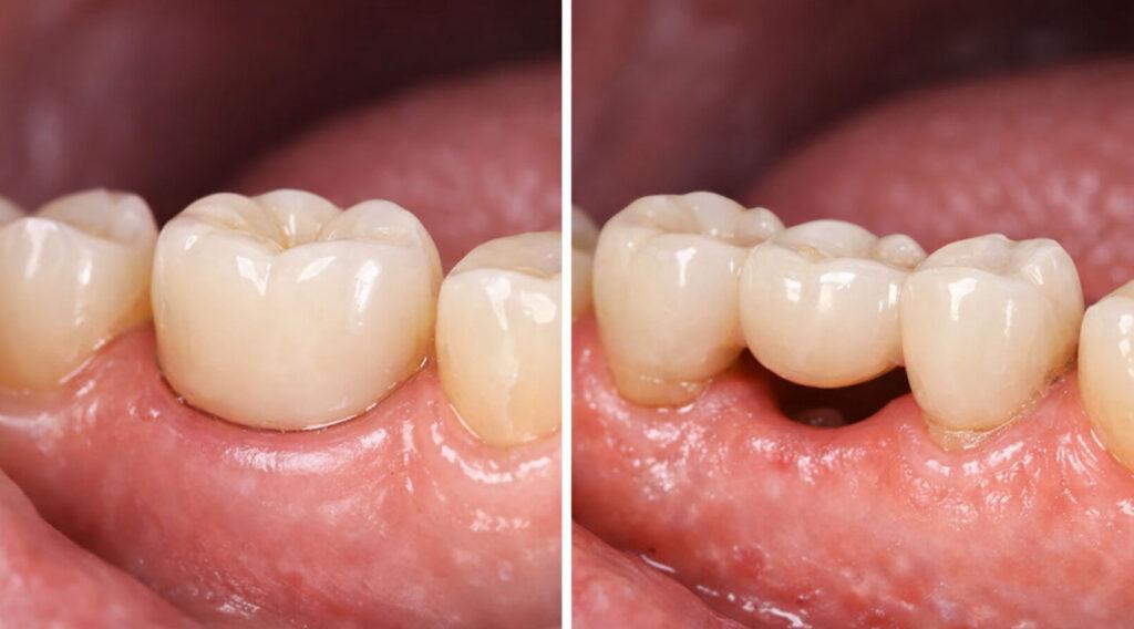 bridge vs implant Carlsbad consultation with dentist