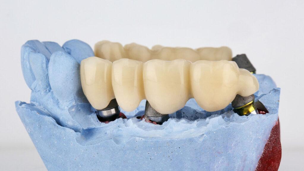 dental bridge pros and cons overview