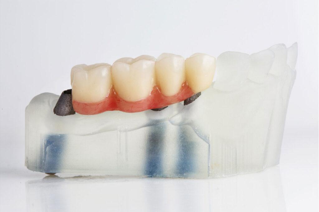 dental bridge replacing missing tooth Carlsbad