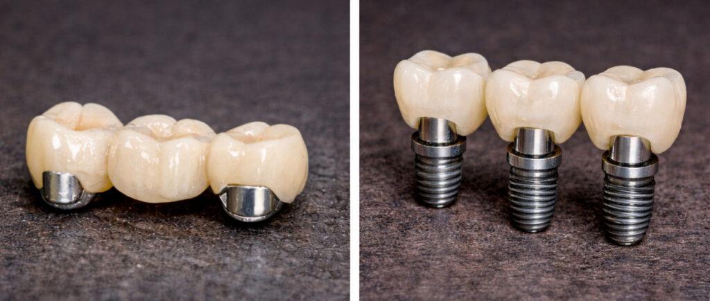 dental bridge vs implant pros and cons chart