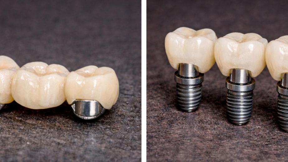 dental bridge vs implant pros and cons chart