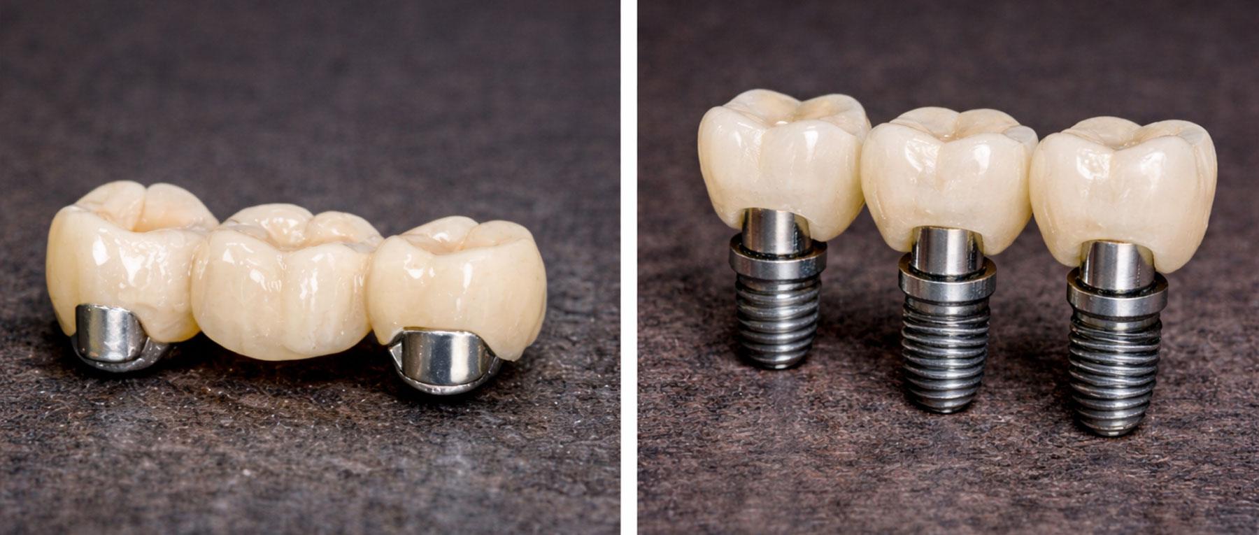 dental bridge vs implant pros and cons chart