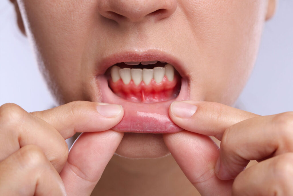 swollen gums around partially erupted wisdom tooth