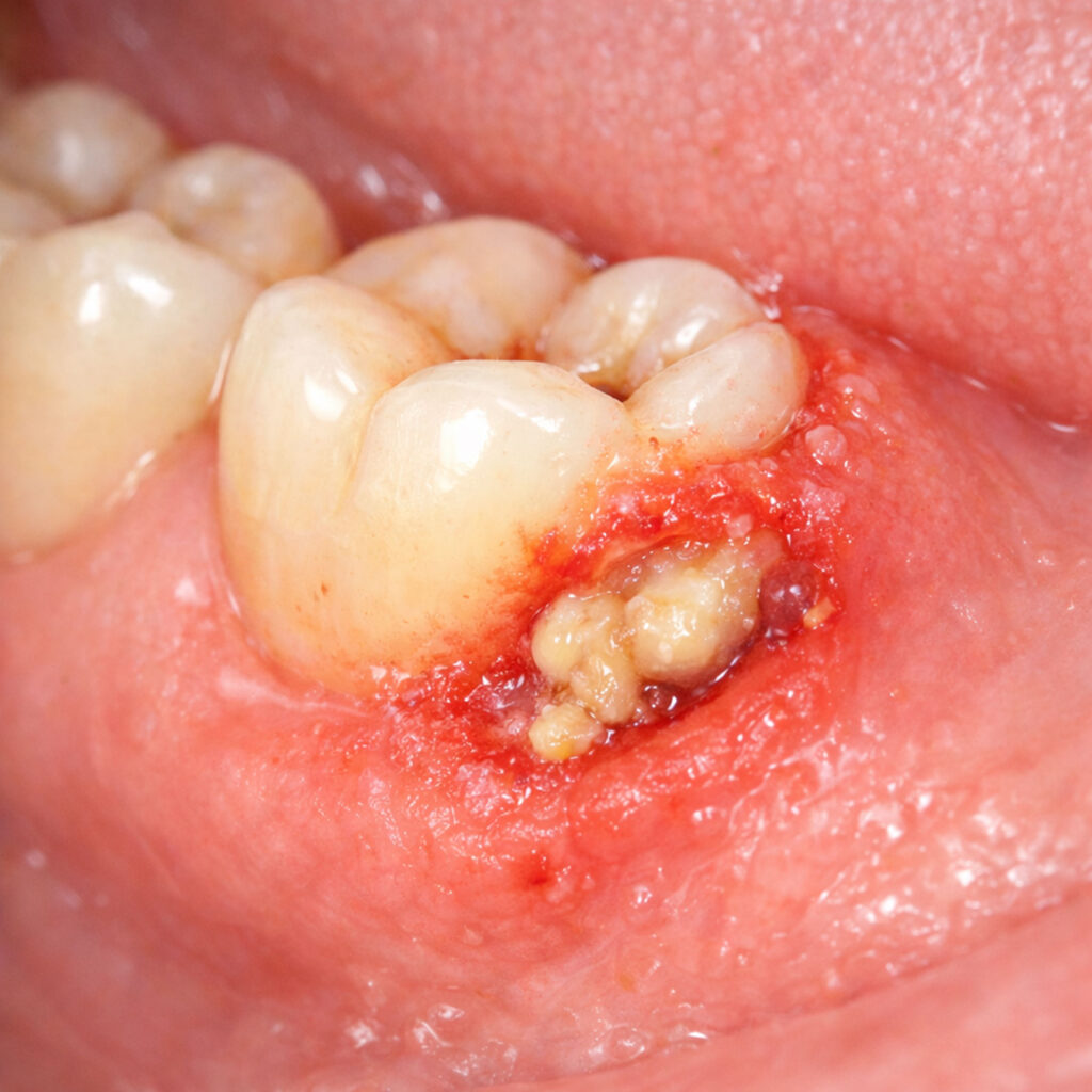 pericoronitis around lower impacted wisdom tooth