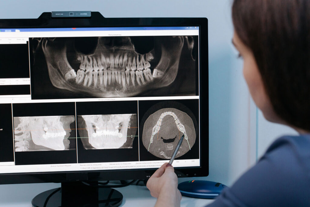 dentist x ray wisdom tooth infection risks
