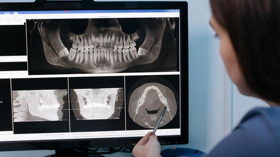 dentist x ray wisdom tooth infection risks