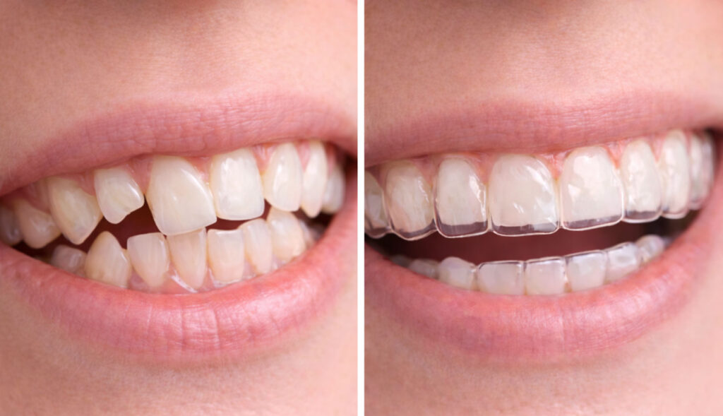 before and after Invisalign clear aligners smile result