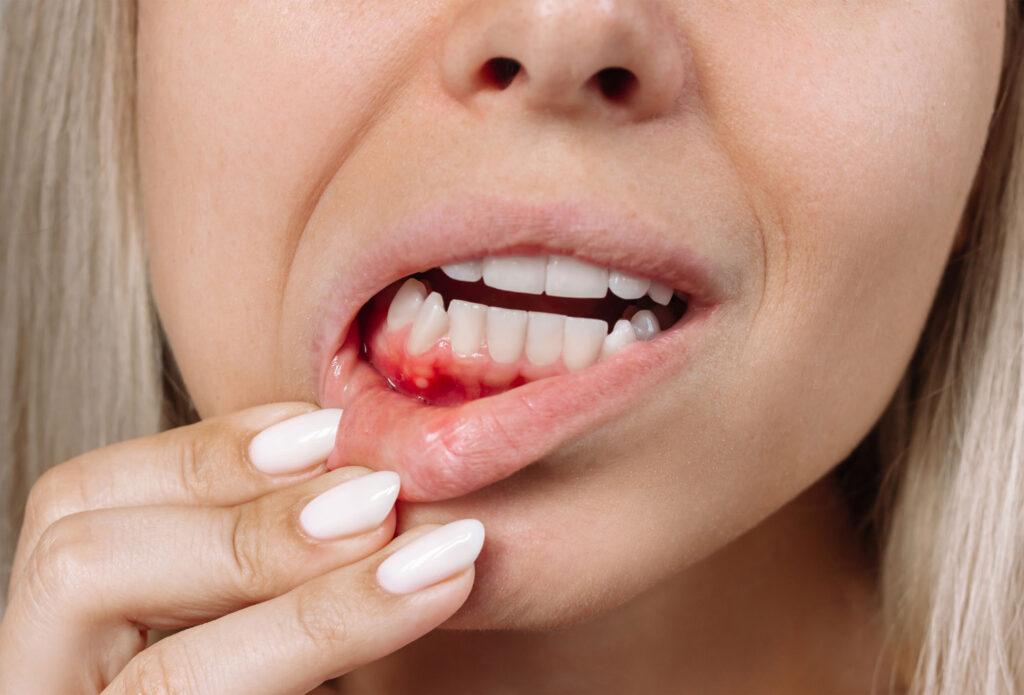 gum disease prevention