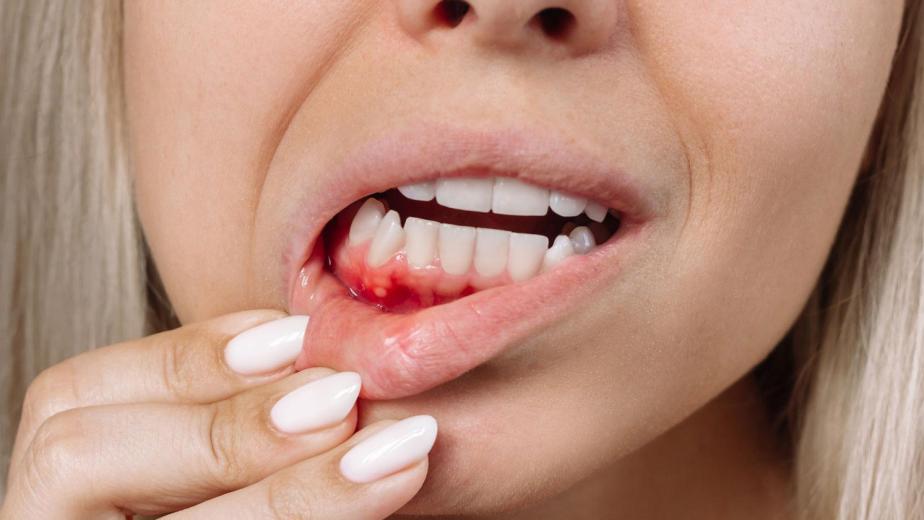 gum disease prevention