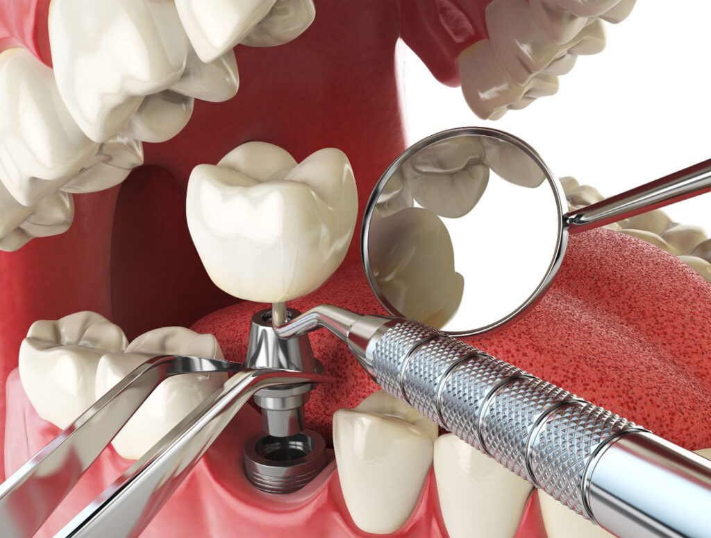 Overview of the Dental Implant Procedure