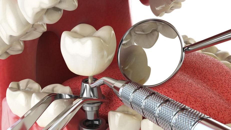 Overview of the Dental Implant Procedure