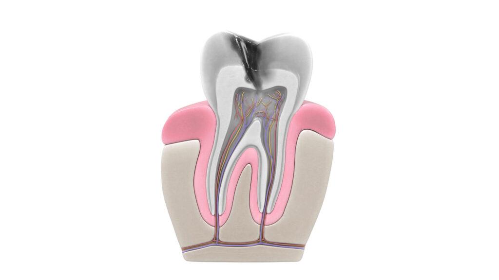 dentist explaining root canal symptoms on dental x-ray
