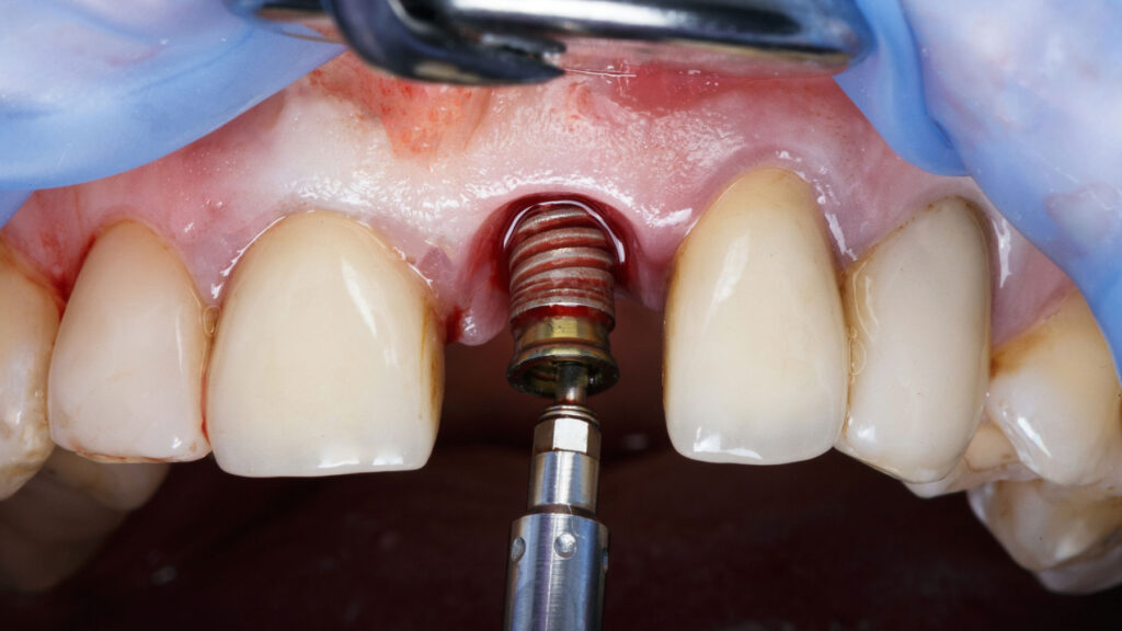 dentist placing titanium dental implant post in jawbone