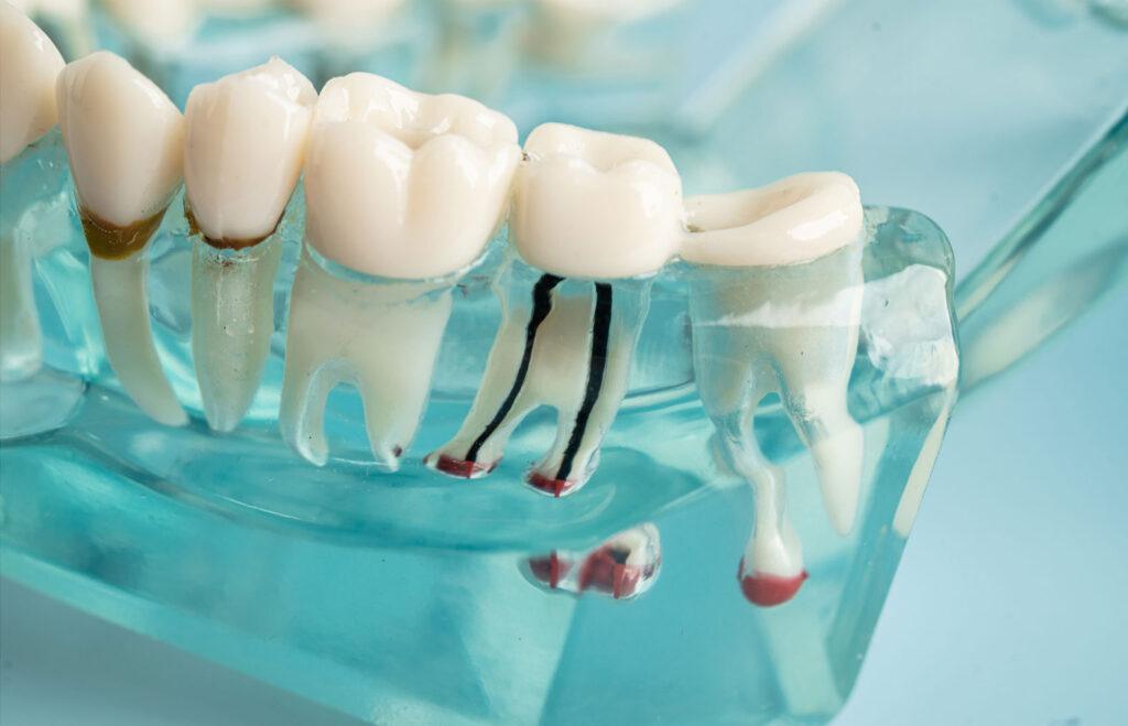 root canal symptoms causing tooth pain in Carlsbad