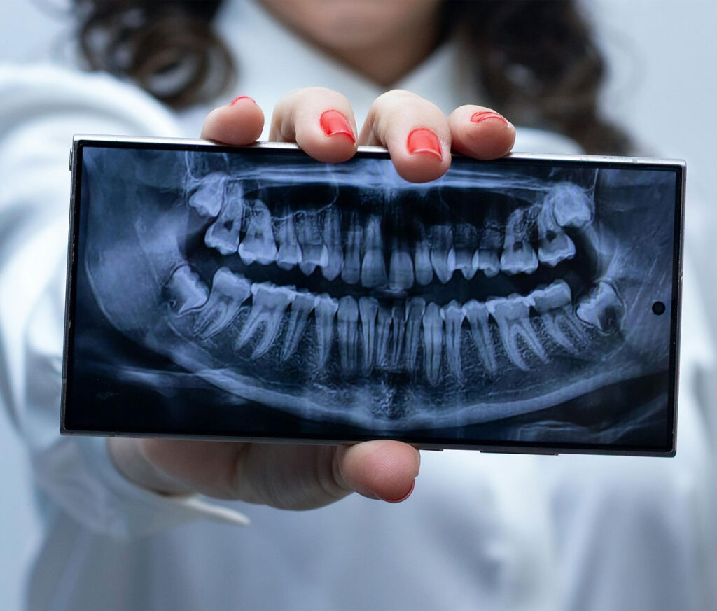 dental implant planning with jawbone X-ray and surgical guide