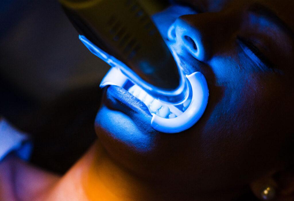 custom whitening trays for at-home Zoom maintenance