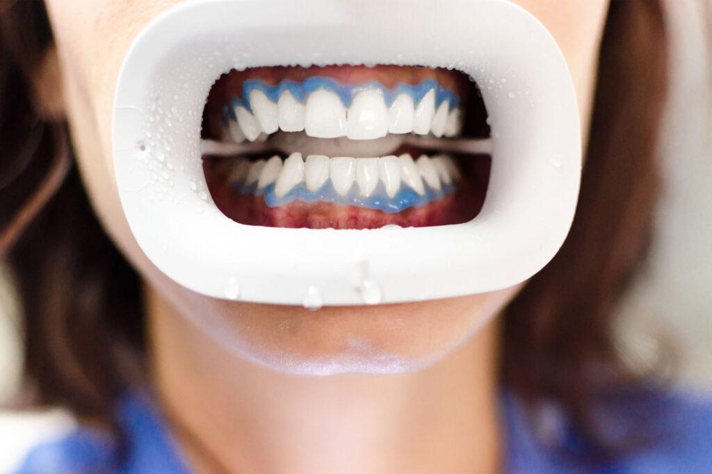 patient with sensitive teeth getting Zoom whitening