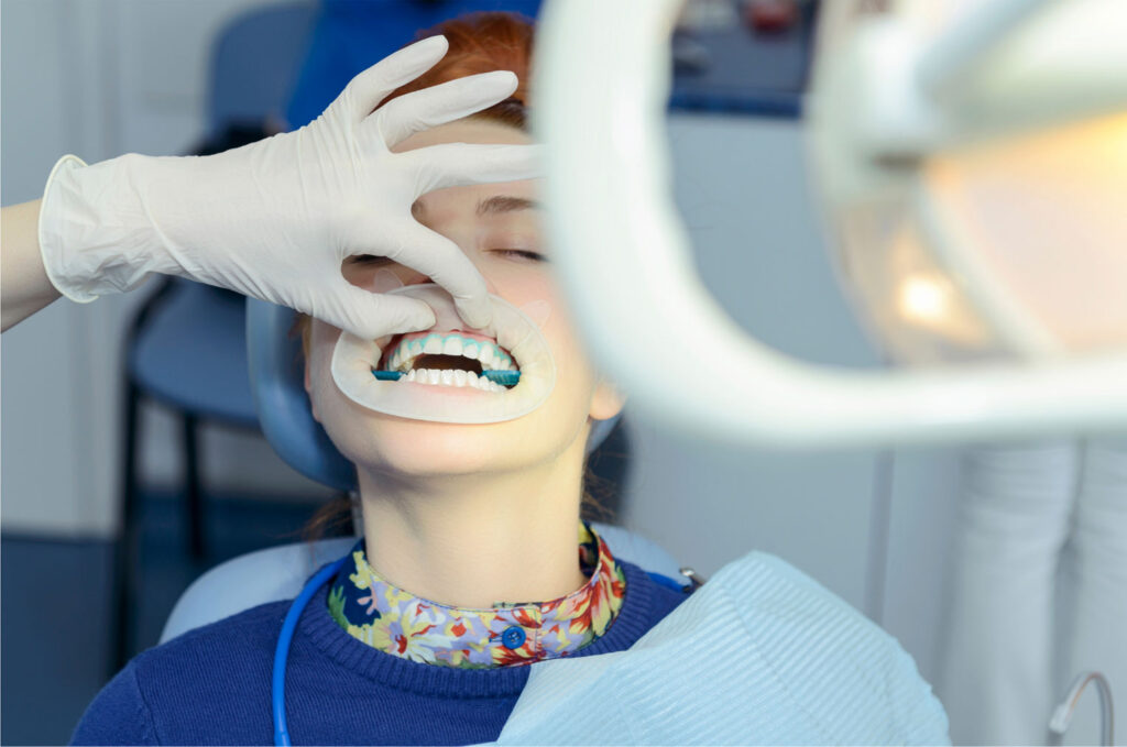 patient receiving professional teeth whitening treatment in Carlsbad
