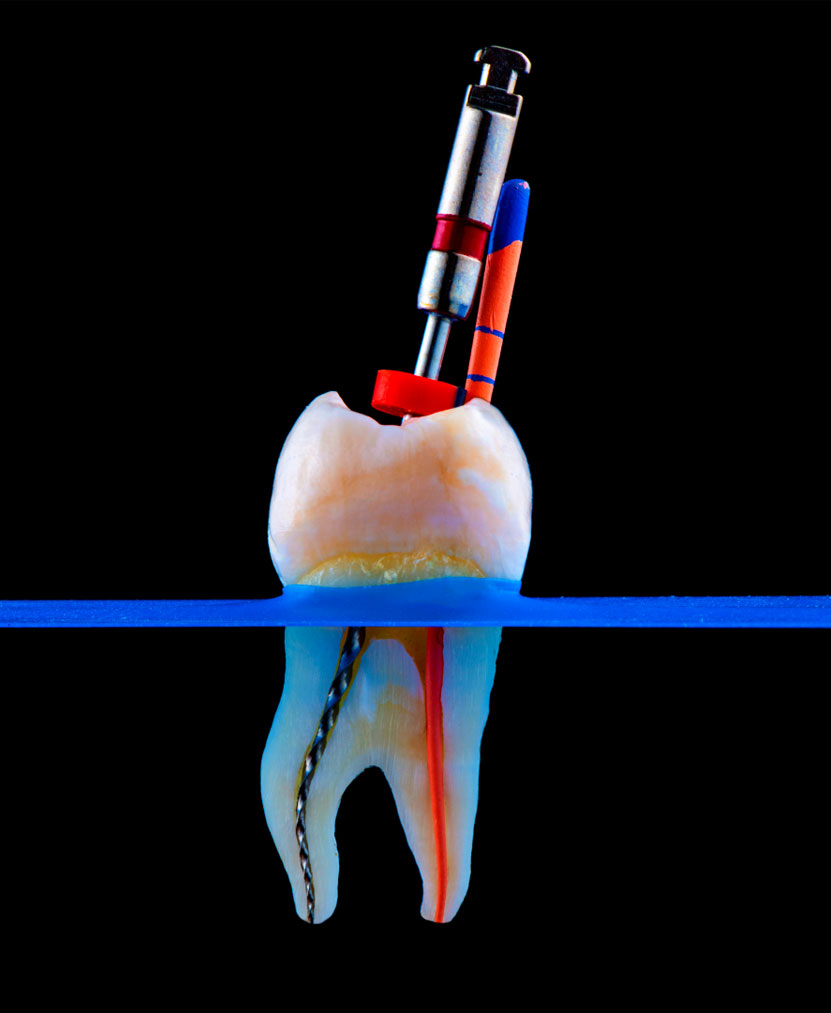 root canal preparation checklist at Smiles for Health