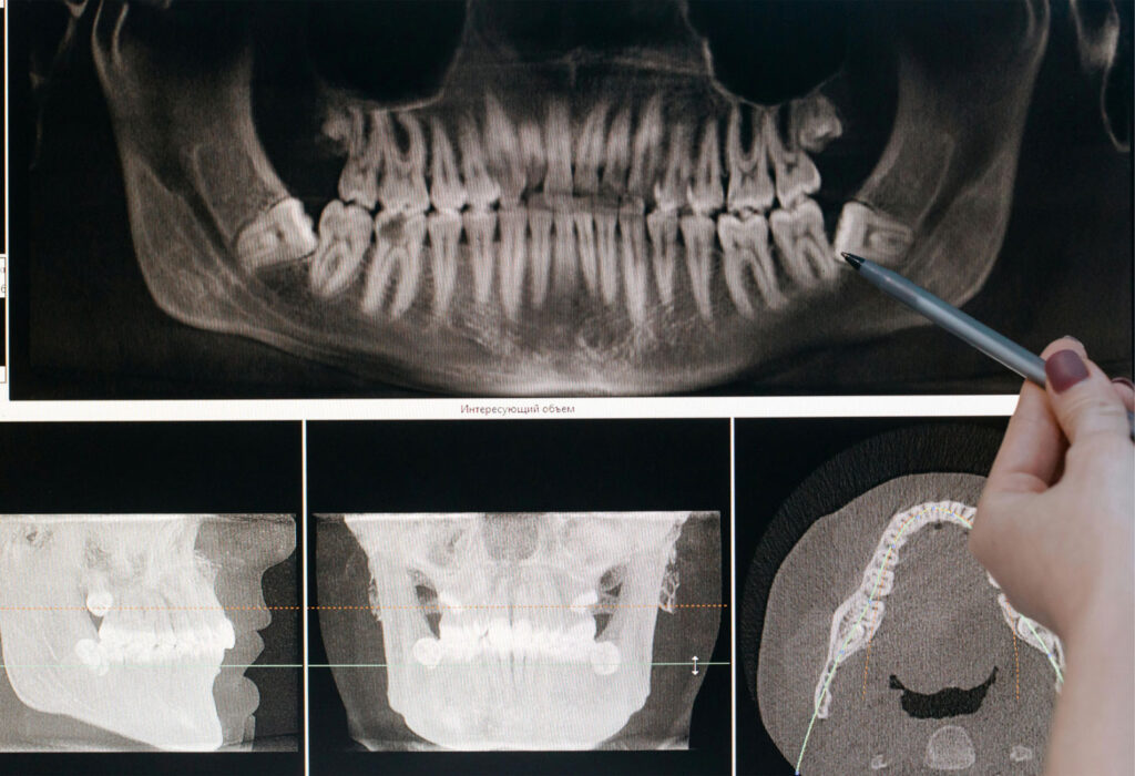 dental x-ray showing abscessed tooth and infection