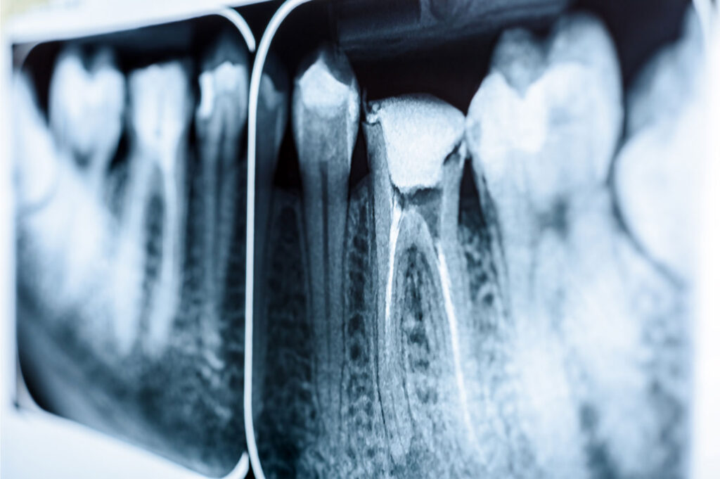 dental x-ray used to plan root canal treatment