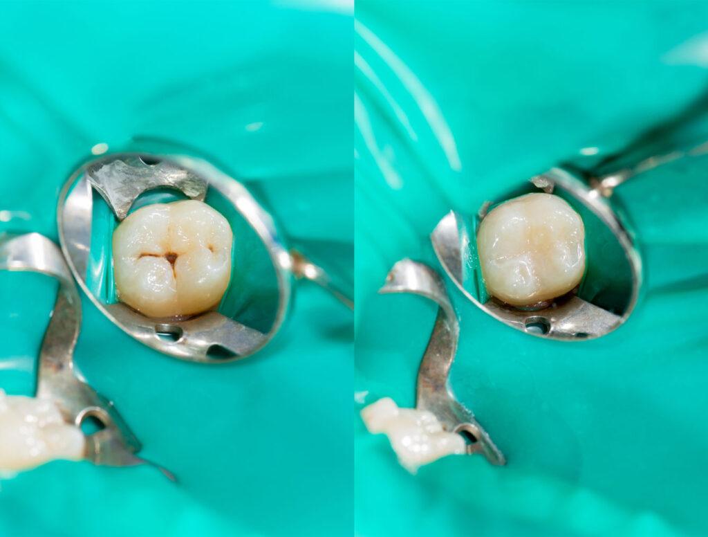 before and after dental sealants on chewing surfaces