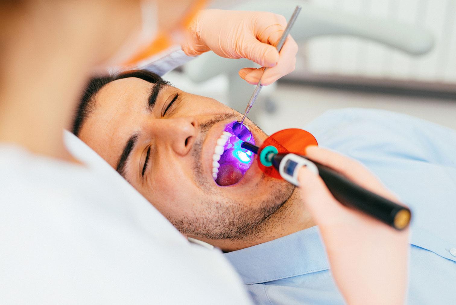 dental sealants applied to molars in Carlsbad