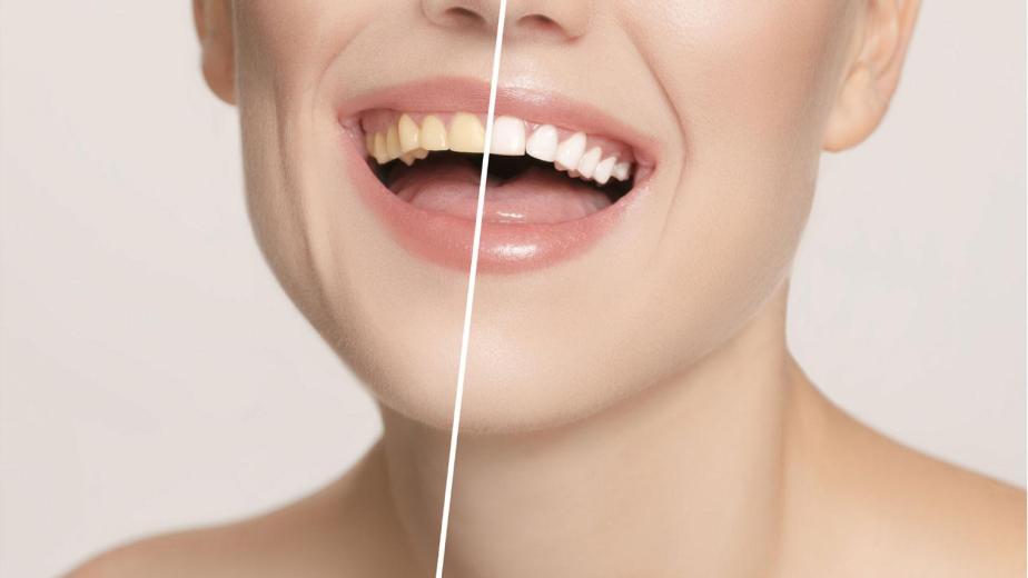 professional teeth whitening before and after smile