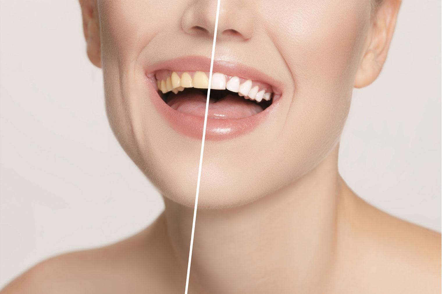 professional teeth whitening before and after smile