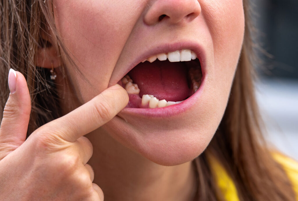 gum disease bone loss leading to tooth extraction