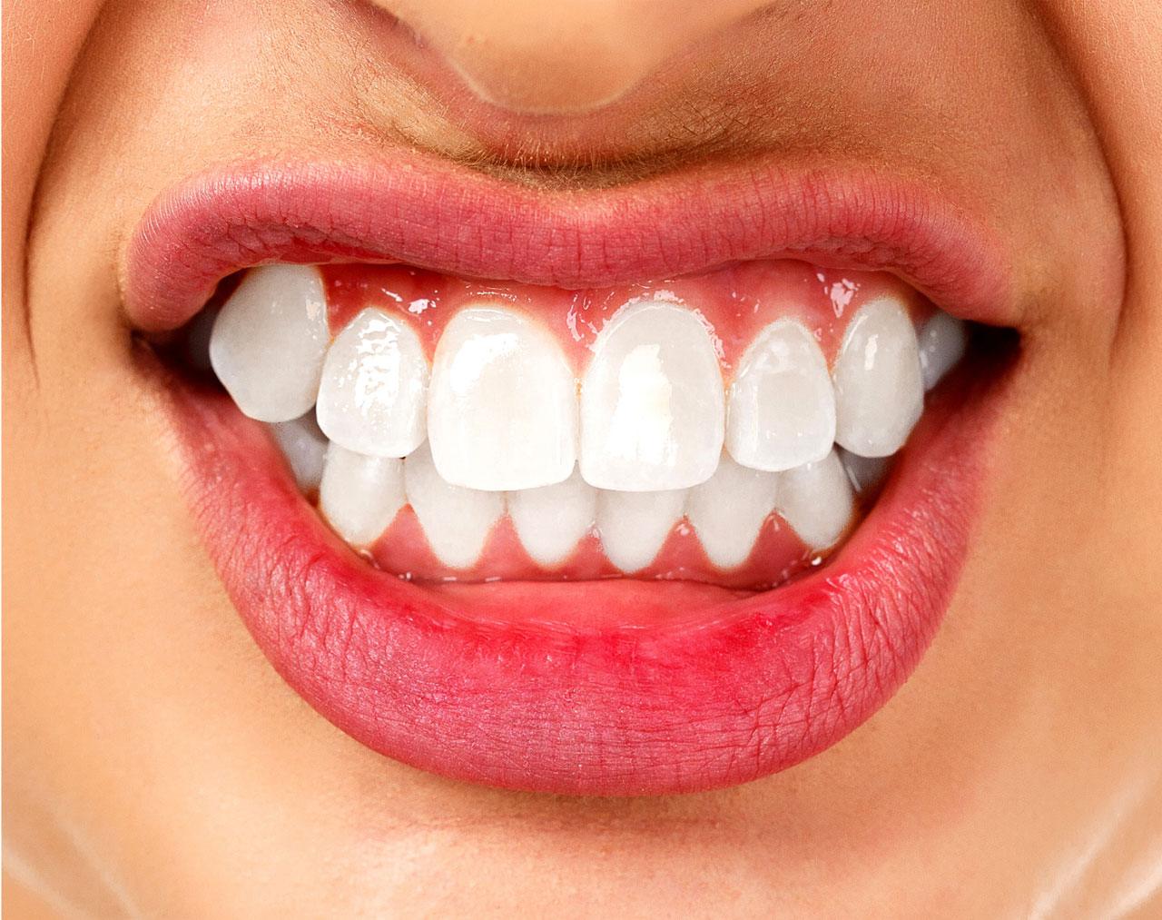 tooth with bruxism