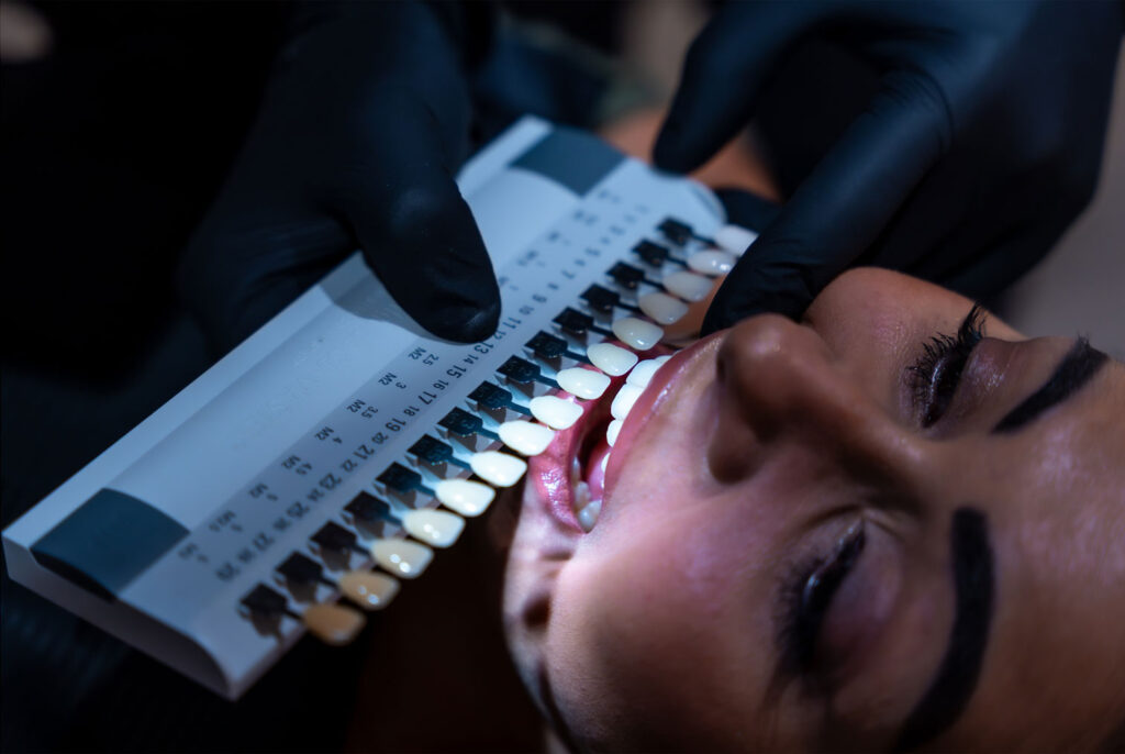 dentist checking tooth shade guide before whitening