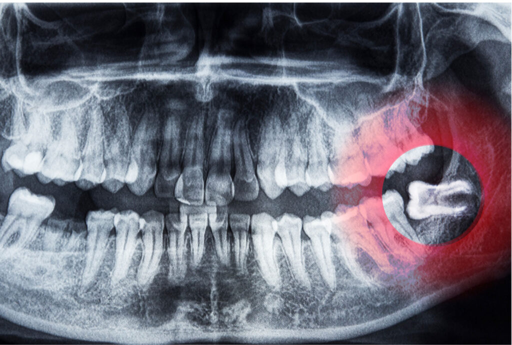 x-ray showing tooth extraction need