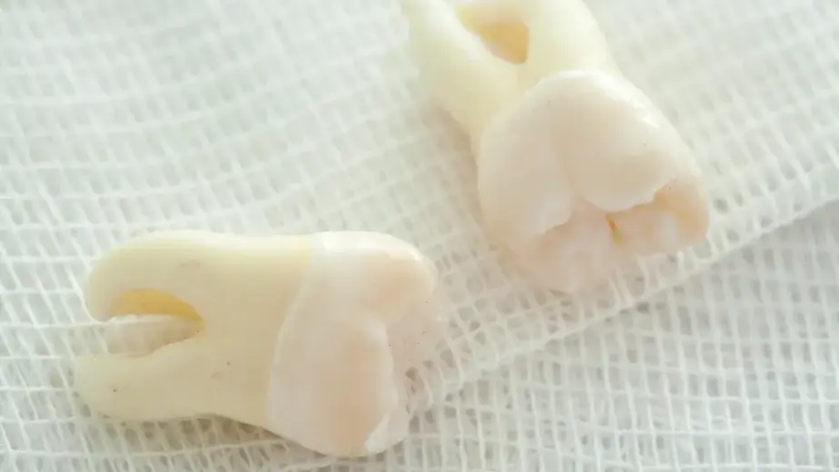tooth extraction in Carlsbad